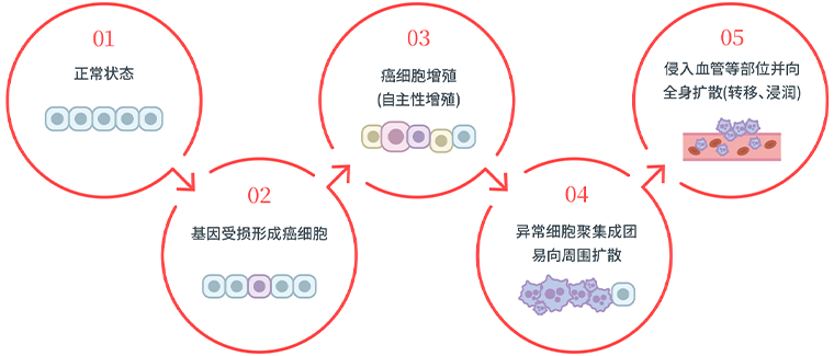 1.正常状态→2.基因受损形成癌细胞→3.癌细胞增殖（自主性增殖）→4.异常细胞聚集成团，易向周围扩散→5.侵入血管等部位并向全身扩散（转移、浸润）